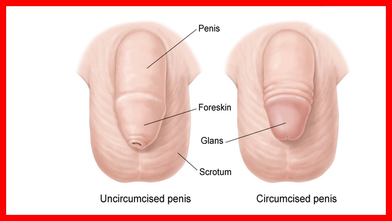 pene circumcisio